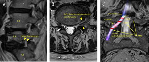 l5 nerve root irritation